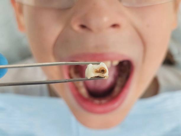 Best Emergency Tooth Extraction in Tamiami, FL