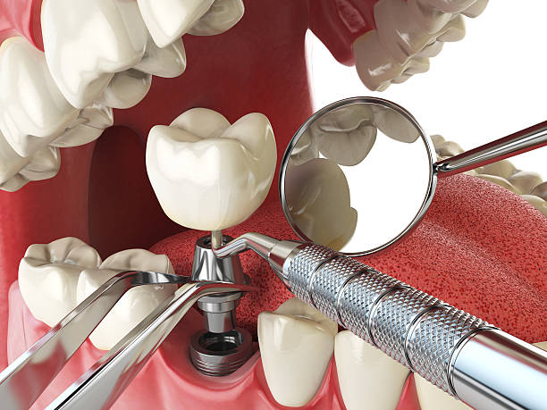 Best Emergency Wisdom Teeth Removal in Tamiami, FL